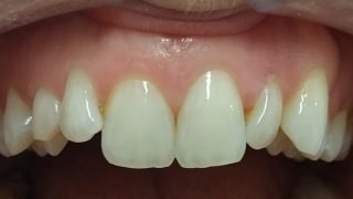 Laura - Composite Veneers before
