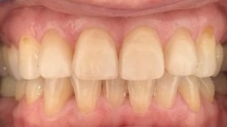 Liz - Composite Veneers after