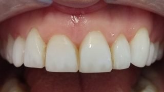 Laura - Composite Veneers after