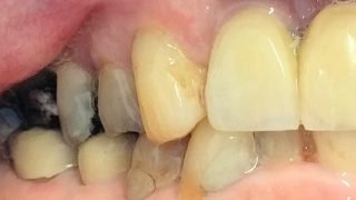 Rachel - Composite Veneers before