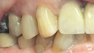 Rachel - Composite Veneers after