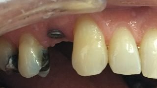 Robert - Dental Implants before