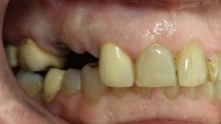 Rob - Dental Implants before