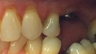 Maria - Dental Implants before