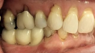Mary - Dental Implants after