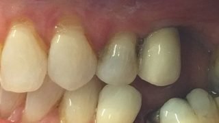 Maria - Dental Implants after