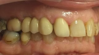 Rob - Dental Implants after