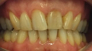 Gary - Teeth Whitening before