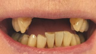 Joan - Dental Implants before