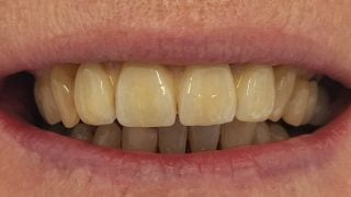 Joan - Dental Implants after