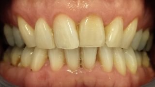 Gary - Teeth Whitening after