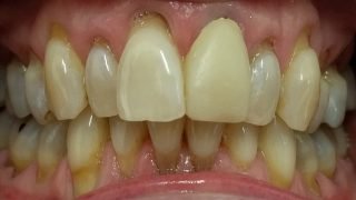 Julie - Porcelain Crowns, Teeth Whitening before