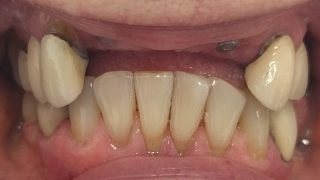 Catriona - Dental Implants, Porcelain Crowns before