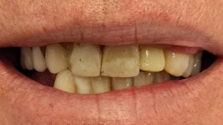 Malcolm - Porcelain Crowns, Composite Veneers before