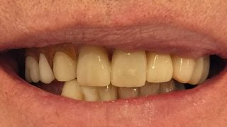 Malcolm - Porcelain Crowns, Composite Veneers after