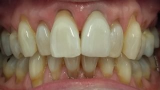 Julie - Porcelain Crowns, Teeth Whitening after