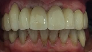 Catriona - Dental Implants, Porcelain Crowns after