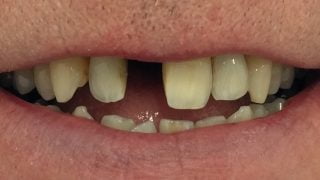 Matt - Dental Implants before