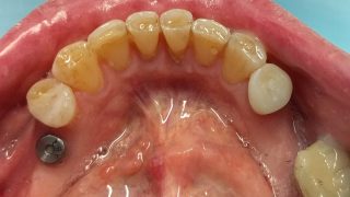Angela - Dental Implants before