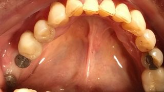 Geoff - Dental Implants before