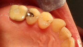 Irene - Dental Implants after