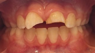 Oliver - Tooth-Coloured Fillings before