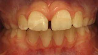Oliver - Tooth-Coloured Fillings after