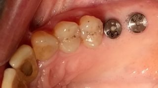 Joan - Dental Implants before