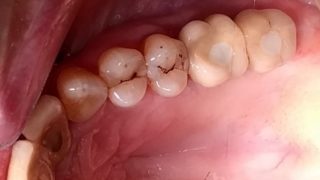 Joan - Dental Implants after