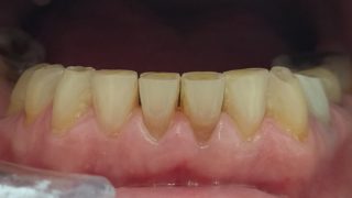 Christine - Composite Veneers before