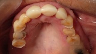 Christine - Porcelain Crowns, Tooth-Coloured Fillings before