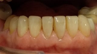 Christine - Composite Veneers after
