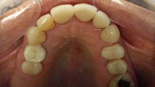 Christine - Porcelain Crowns, Tooth-Coloured Fillings after