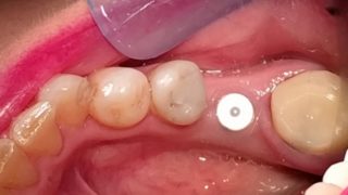 Joanne - Dental Implants, Porcelain Crowns before