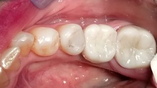 Joanne - Dental Implants, Porcelain Crowns after