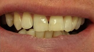 Antony - Teeth Whitening after