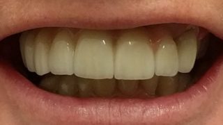 Daphne - Dental Implants after