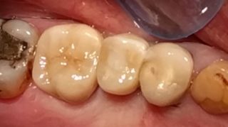 Catherine - Dental Implants after