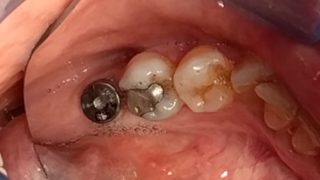 Carol - Dental Implants before