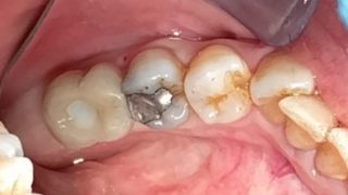 Carol - Dental Implants after