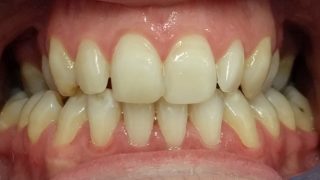 Chloe - Composite Bonding, Teeth Whitening before