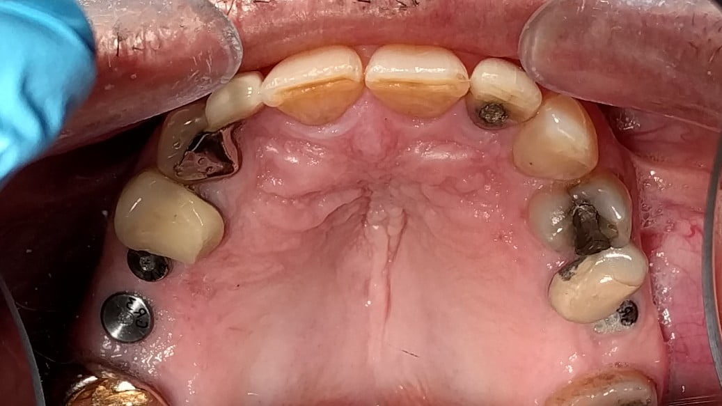 Grant - Dental Implants before