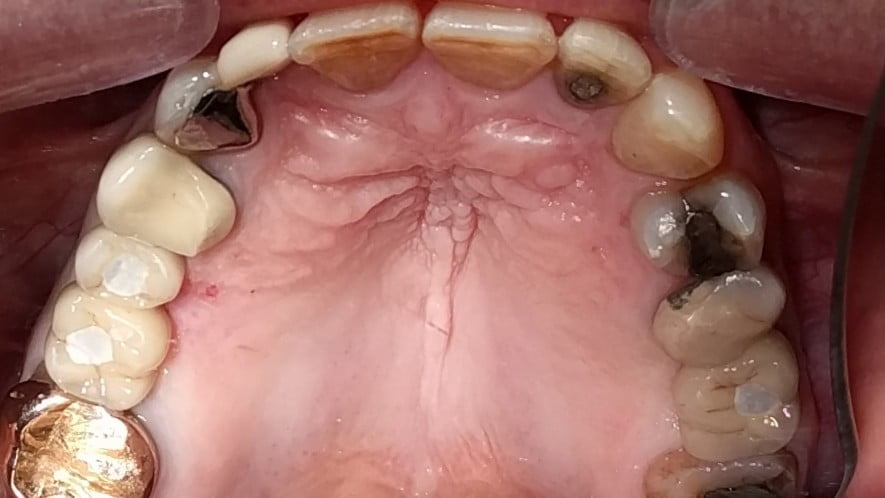 Grant - Dental Implants after
