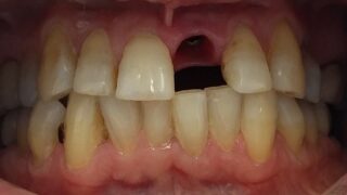 Antony - Dental Implants before