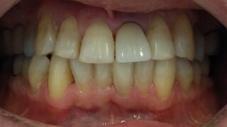 Antony - Dental Implants after