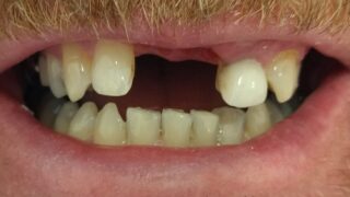 Terry - Dental Implants before