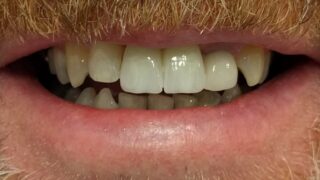 Terry - Dental Implants after