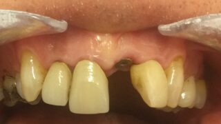 Kevin - Dental Implants before