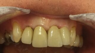 Kevin - Dental Implants after