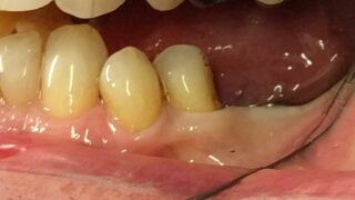 Bill - Dental Implants before